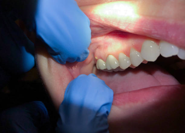 Best Urgent Tooth Repair  in Nescopeck, PA